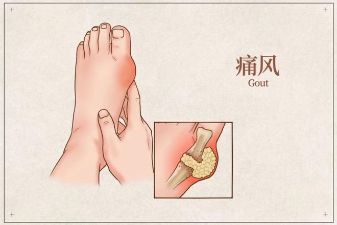 高尿酸=痛风？降尿酸饮食运动攻略来啦！(图1)
